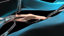 Carotid Endarterectomy