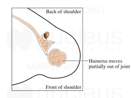 Subluxation of the Shoulder Joint