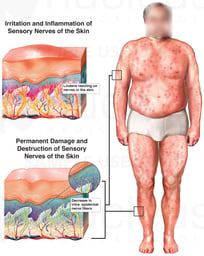 Permanent Damage and Destruction of Sensory Nerves of the Skin Due to Apllication of Lindane