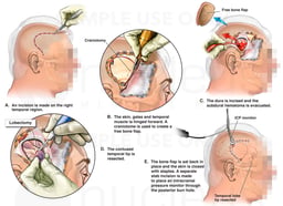 Brain Surgery