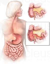 Crohn's Disease