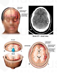 Closed head Injuries : Contusion and Hemorrhage