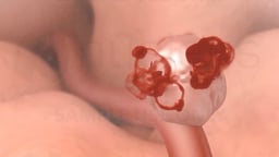 Overview of Hemorrhagic Stroke and Treatment