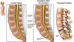 Lumbar Spine Injury - L2-3, L3-4 Disc Bulges and L4-5 Spondylolisthesis with Proposed Spinal Fusion Surgery