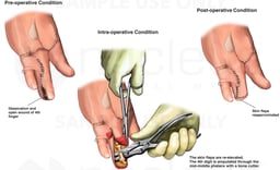 Partial Fourth Finger Amputation