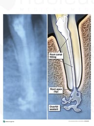 Root Canal Overfill