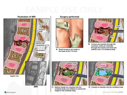 Thoracic Spine Burst Fracture with Surgical Kyphoplasty