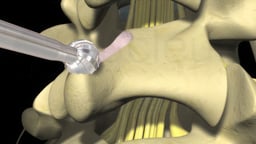 Lumbar Laminectomy