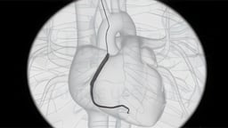 Coronary Artery Angiography (Cardiac Catheterization)