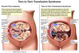 Twin to Twin Transfusion Syndrome
