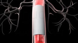 Open Abdominal Aortic Aneurysm Repair: Restored Bloodflow