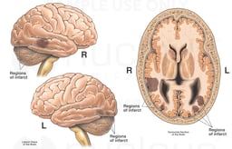 Brain Injury to the Cerebrum and Cerebellum