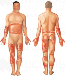 60 Percent Total Body Surface Area Burns