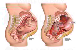 Complete Rupture of Previous Cesarean Scar of Uterus