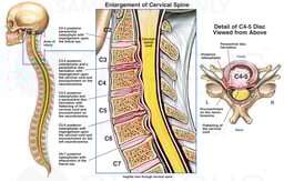 Post-accident Cervical Spine Injuries