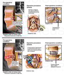 Lumbar Injuries with Posterior Decompression and Anterior Fusion Surgeries