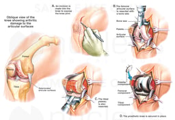 Total Right Knee Replacement Surgery