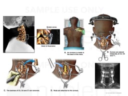 Non-union of Previous Cervical Fusion with Posterior Multilevel Fusion