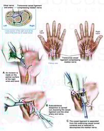 Bilateral Carpal Tunnel Syndrome and Surgical Repair
