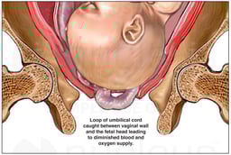 Prolapse of Umbilical Cord