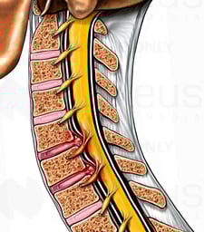 Cervical Disc Herniations at C5-6 and C6-7