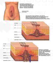 Septic Surgical Wound Following Abdominal Surgery