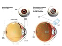 Placement of Intraocular Lens with Blockage of Fluid Flow Within the Eye