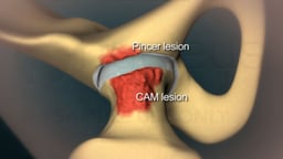 Femoroacetabular Impingement in the Hip