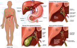 Cholecystectomy with Injury to the Common Hepatic and Common Bile Ducts