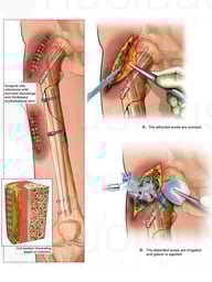 Right Thigh Surgical Infection with Irrigation and Debridement