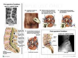 Lumbar Spine Injury with Surgical Decompression and Fusion