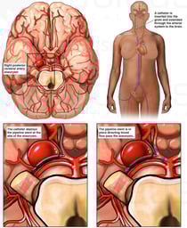 Aneurysm in Posterior Cerebral Artery