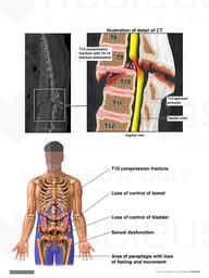 Spinal Injury with Resulting Paraplegia