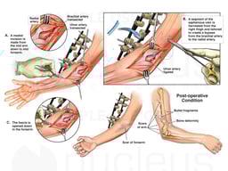 Right Arm Vascular Injuries with Surgical Repair