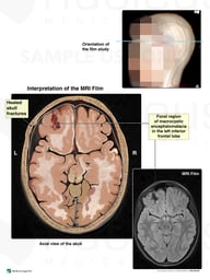 MRI Evidence of Brain Injury