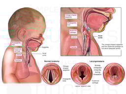 Anatomy of Pediatric Airway with Severe Laryngomalacia