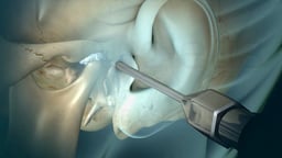 Surgical Treatments for TMJ Disorders (TMD)