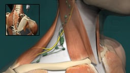 Lymph Node Biopsy with Spinal Accessory Nerve Injury and Subsequent Right Shoulder Muscle Palsy and Transfer Procedure