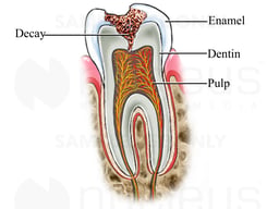Tooth Decay
