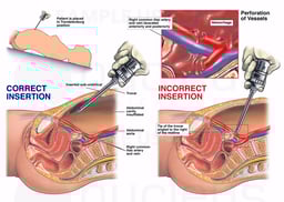 Surgical Laparoscopy with Injury to the Iliac Artery and Vein