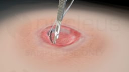 Surgical Debridement