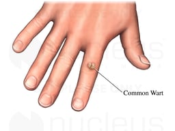 Common Wart