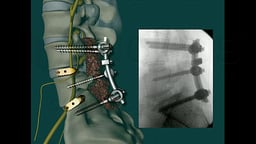 Lumbar Spine injuries with Double level Surgical Decompression and Fusion