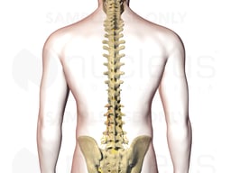 Inflammation of Left Lumbar Nerves