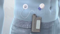 Treatment Options for Type 1 Diabetes