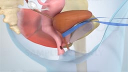 Tension-free Vaginal Tape (TVT) Procedure