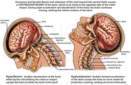 Cervical Hyperflexion and Hyperextension with Brain Injury
