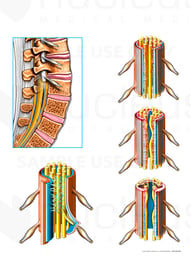 Arachnoiditis of the Lumbo-sacral Spine