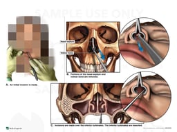 Surgical Septoplasty and Inferior Turbinate Resection