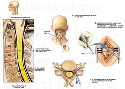 Neck Injuries - C3-4, C4-5 Disc Herniations and C5-7 Osteophytes
